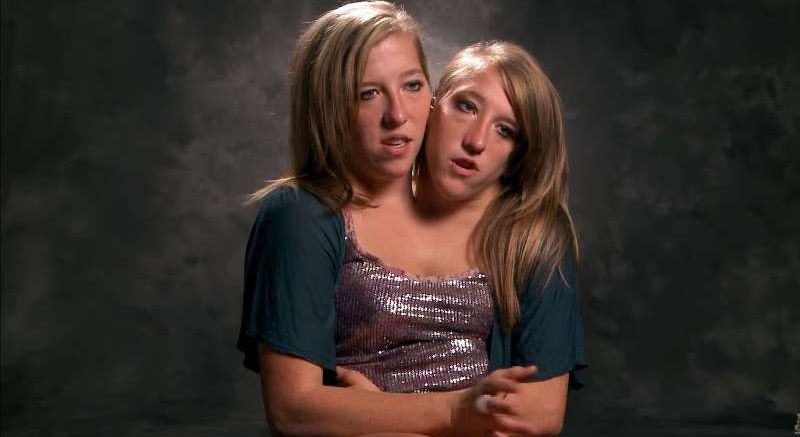 Conjoined twins abby and brittany marriage